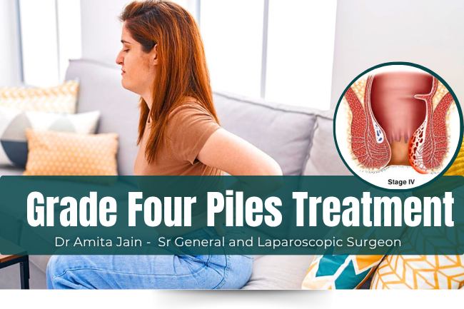 Dr Amita Jain Treatment for Grade Four Piles or Internal Hemorrhoid
